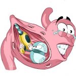 Cơ chế bệnh sinh loét dạ dày tá tràng