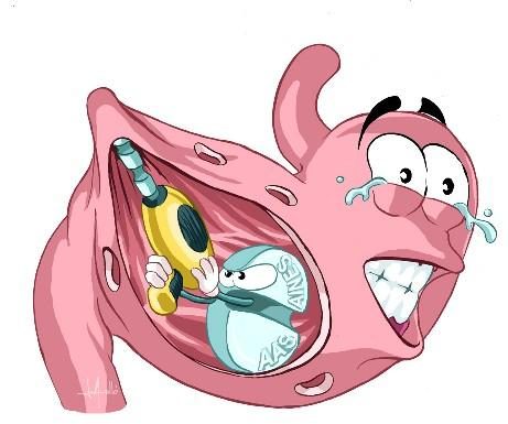 Cơ chế bệnh sinh loét dạ dày tá tràng