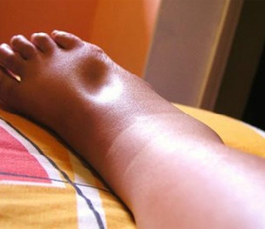 Thiểu năng tuyến nội tiết. Cơ chế phù và các loại phù