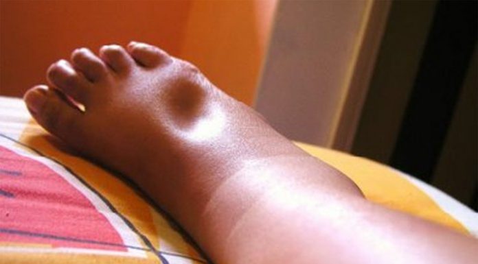 Thiểu năng tuyến nội tiết. Cơ chế phù và các loại phù