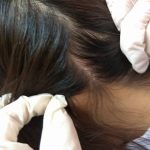 Một số nguyên nhân gây bệnh nấm da đầu