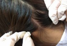 Một số nguyên nhân gây bệnh nấm da đầu