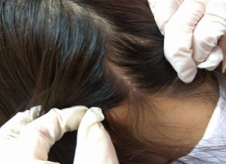 Một số nguyên nhân gây bệnh nấm da đầu