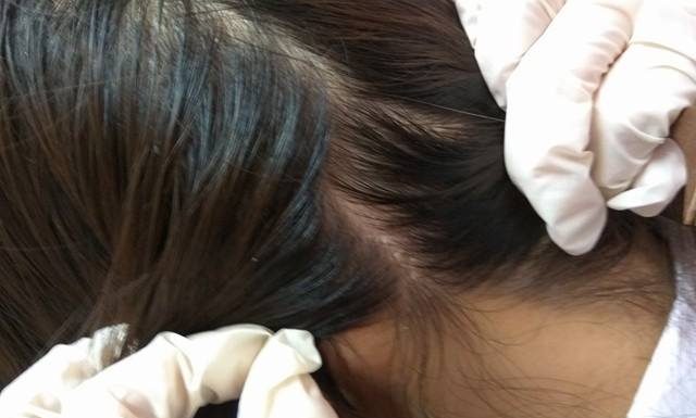 Một số nguyên nhân gây bệnh nấm da đầu