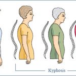 Các loại thực phẩm dễ gây loãng xương