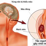 Rối loạn vi tuần hoàn cục bộ