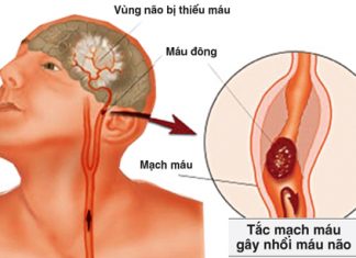 Rối loạn vi tuần hoàn cục bộ