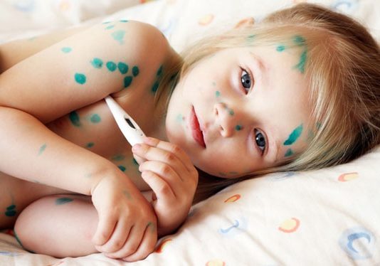 NHỮNG ĐIỀU CẦN BIẾT VỀ BỆNH THỦY ĐẬU