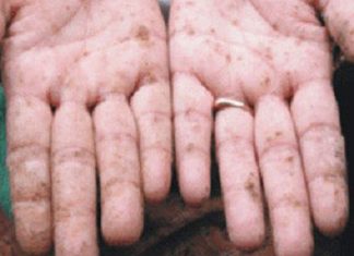 Tác hại của chì và đồng