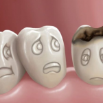 Sâu răng và các biện pháp dự phòng sâu răng