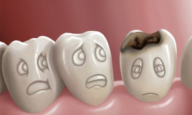 Sâu răng và các biện pháp dự phòng sâu răng