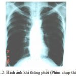 CHẨN ĐOÁN BỆNH PHỔI TẮC NGHẼN MÃN TÍNH.