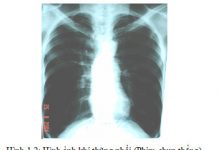 CHẨN ĐOÁN BỆNH PHỔI TẮC NGHẼN MÃN TÍNH.