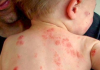 Căn nguyên của bệnh chàm ( Eczema )