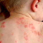 Căn nguyên của bệnh chàm ( Eczema )
