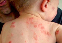 Căn nguyên của bệnh chàm ( Eczema )