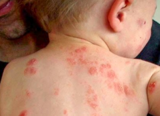 Căn nguyên của bệnh chàm ( Eczema )