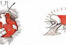 Vỡ tử cung trong thai kì-những điều cần lưu ý