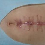 Vai trò của dinh dưỡng với các bệnh nhiễm khuẩn, bệnh mạn tính và miễn dịch