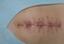 Vai trò của dinh dưỡng với các bệnh nhiễm khuẩn, bệnh mạn tính và miễn dịch