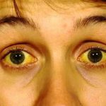 PHÒNG CHỐNG DỊCH VIÊM GAN VIRUS.