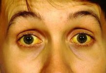 PHÒNG CHỐNG DỊCH VIÊM GAN VIRUS.