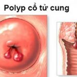 Những vấn đề chị em cần lưu ý về chảy máu bất thường ở tử cung