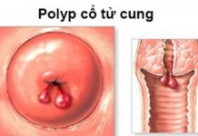 Những vấn đề chị em cần lưu ý về chảy máu bất thường ở tử cung