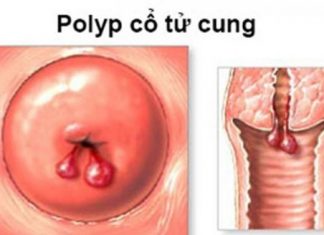 Những vấn đề chị em cần lưu ý về chảy máu bất thường ở tử cung