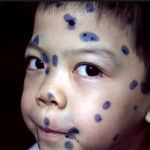 BỆNH BẠI LIỆT HOÀN TOÀN CÓ THỂ PHÒNG ĐƯỢC BẰNG VACXIN