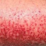 Sốt xuất huyết Dengue-mối lo ngại mùa hè này