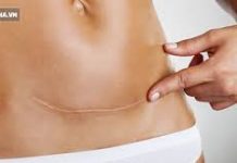 Những điều cần biết về vỡ tử cung trong chuyển dạ