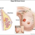 SÀNG LỌC ĐỂ PHÁT HIỆN SỚM UNG THƯ VÚ.