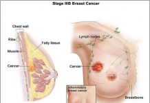 SÀNG LỌC ĐỂ PHÁT HIỆN SỚM UNG THƯ VÚ.