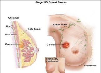 SÀNG LỌC ĐỂ PHÁT HIỆN SỚM UNG THƯ VÚ.