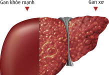 Tư vấn dinh dưỡng trong bệnh xơ gan xơ gan