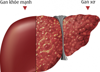 Tư vấn dinh dưỡng trong bệnh xơ gan xơ gan