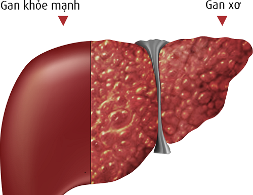 Tư vấn dinh dưỡng trong bệnh xơ gan xơ gan