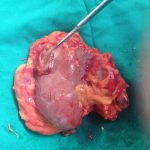 Một số biến chứng sỏi tiết niệu cần lưu ý để tránh khỏi các nguy hiểm