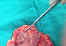 Một số biến chứng sỏi tiết niệu cần lưu ý để tránh khỏi các nguy hiểm