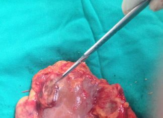 Một số biến chứng sỏi tiết niệu cần lưu ý để tránh khỏi các nguy hiểm