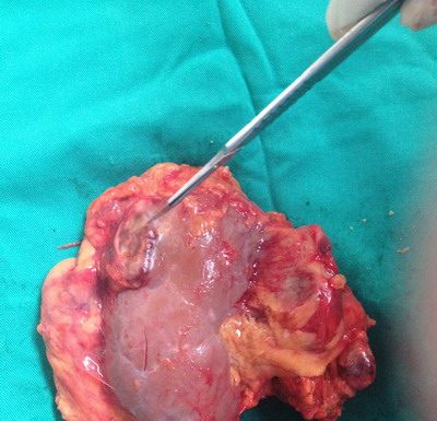 Một số biến chứng sỏi tiết niệu cần lưu ý để tránh khỏi các nguy hiểm