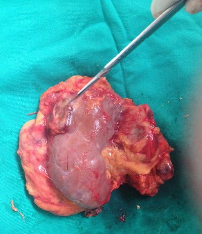 Một số biến chứng sỏi tiết niệu cần lưu ý để tránh khỏi các nguy hiểm