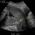 Một số điều cần biết về rau tiền đạo và triệu chứng chẩn đoán