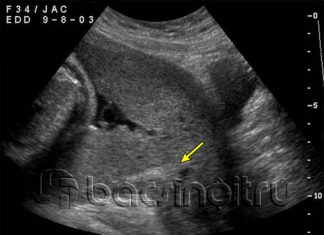 Một số điều cần biết về rau tiền đạo và triệu chứng chẩn đoán