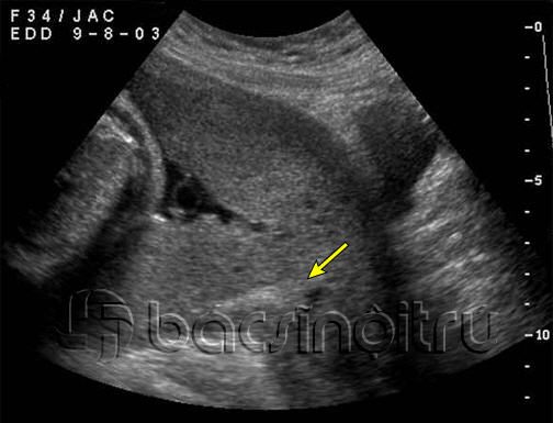 Một số điều cần biết về rau tiền đạo và triệu chứng chẩn đoán