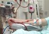 Một số phương pháp điều trị thay thế thận trong suy thận mạn