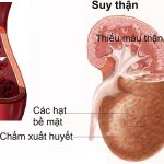 Sự thay đổi dược động học ở bệnh nhân suy giảm chức năng thận