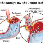 Thăm dò chức năng thực quản, dạ dày
