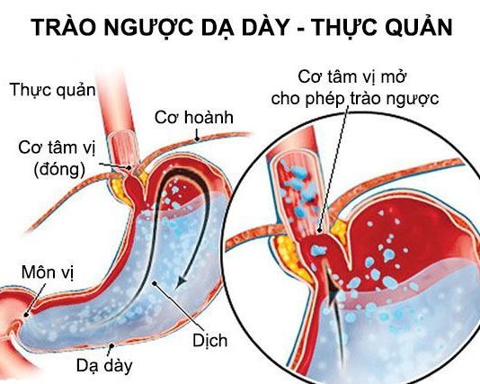 Thăm dò chức năng thực quản, dạ dày